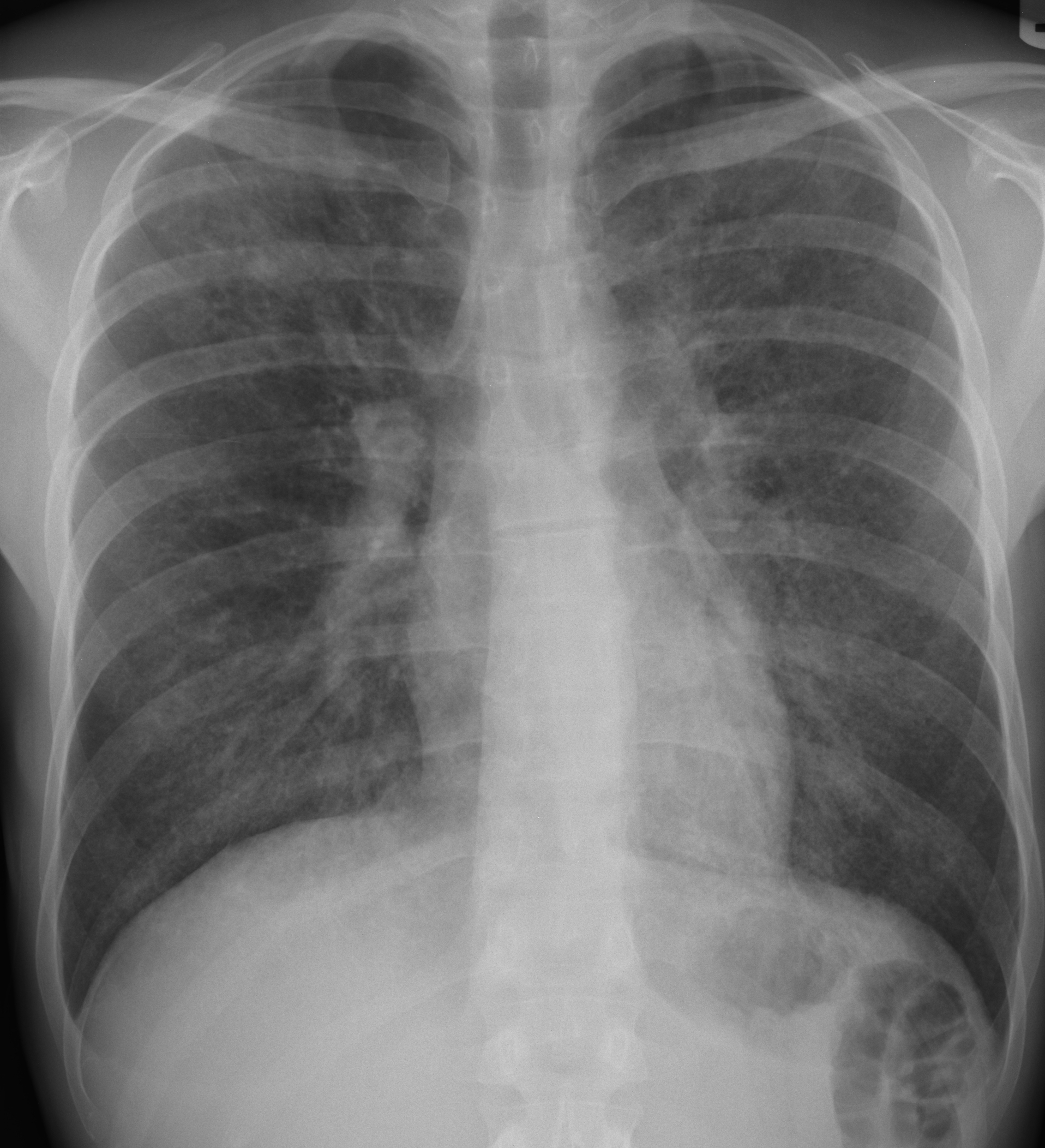 Chest X-ray